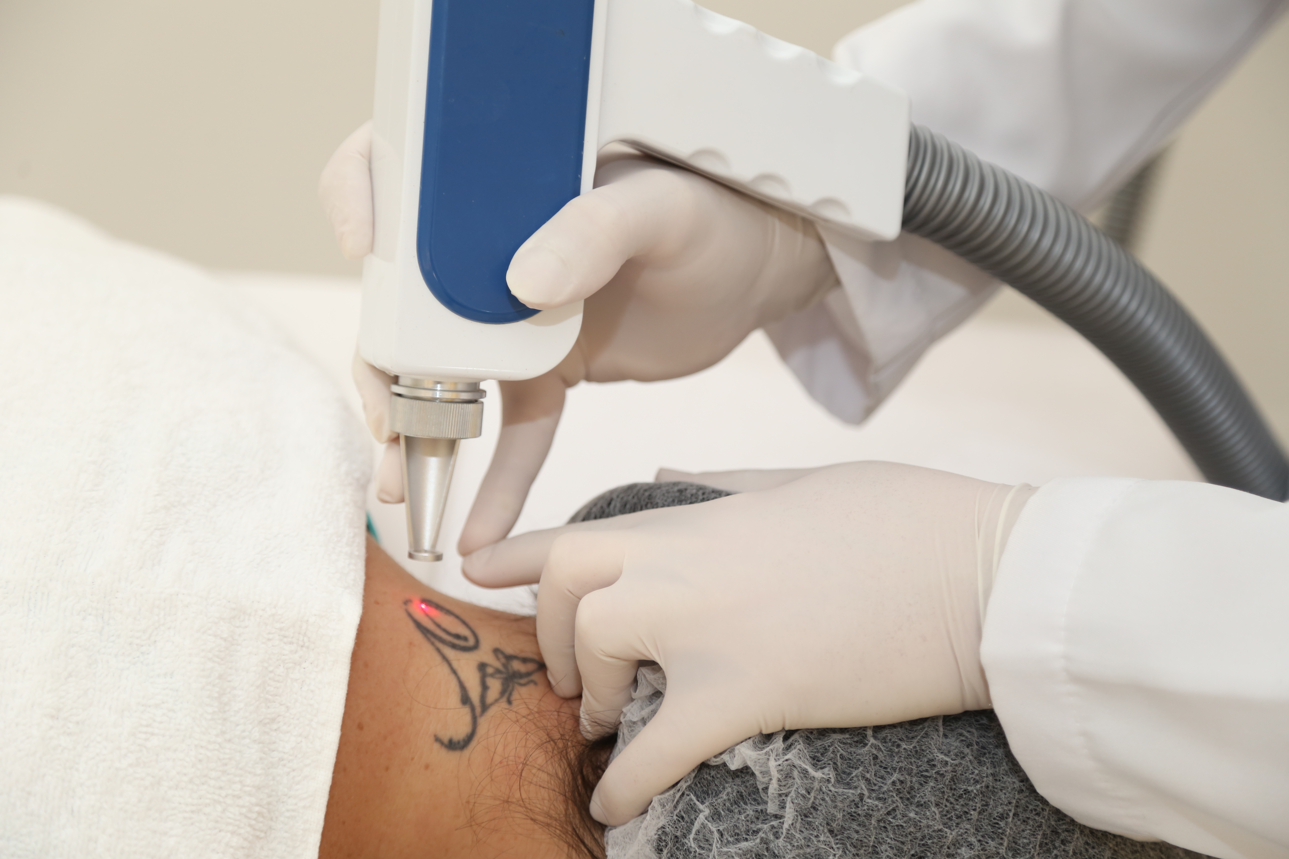 Segundo o especialista, a forma mais eficiente para a retirada de tatuagens é pelo uso de laser